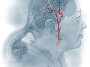 СПАСТИ ЖИЗНЬ! Нейрохирурги РБ №2 – ЦЭМП впервые выполнили ЭИКМА — высокотехнологическую операцию по реконструкции сосудов