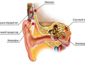 Впервые в Якутии! Выполнена кохлеарная имплантация взрослым с тяжелым поражением слуха